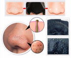 Collage of images showing a nose with blackheads, close-ups of blackheads, and a magnified view of skin texture.